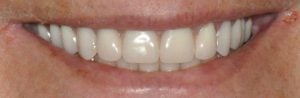 Photo of a patient after All on 4/Teeth in a Day treatment by Dr. Jordan - Andrea E. Jordan, DDS, FACP Santa Rosa CA