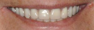 Photo of a patient after All on 4/Teeth in a Day treatment by Dr. Jordan - Andrea E. Jordan, DDS, FACP Santa Rosa CA