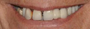 Photo of a patient before All on 4/Teeth in a Day treatment by Dr. Jordan - Andrea E. Jordan, DDS, FACP Santa Rosa CA