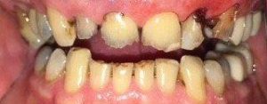 Patient before dental treatment smile