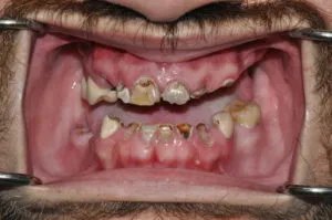 patient before full mouth reconstruction