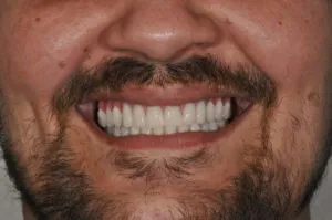 patient after full mouth reconstruction