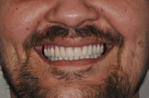 patient after full mouth reconstruction