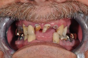 patient before all-on-4 dental implants