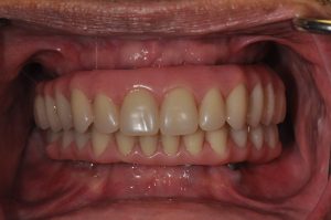 patient after all-on-4 dental implants