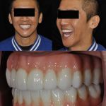 Man smiling after all-on-4 dental implant restorations