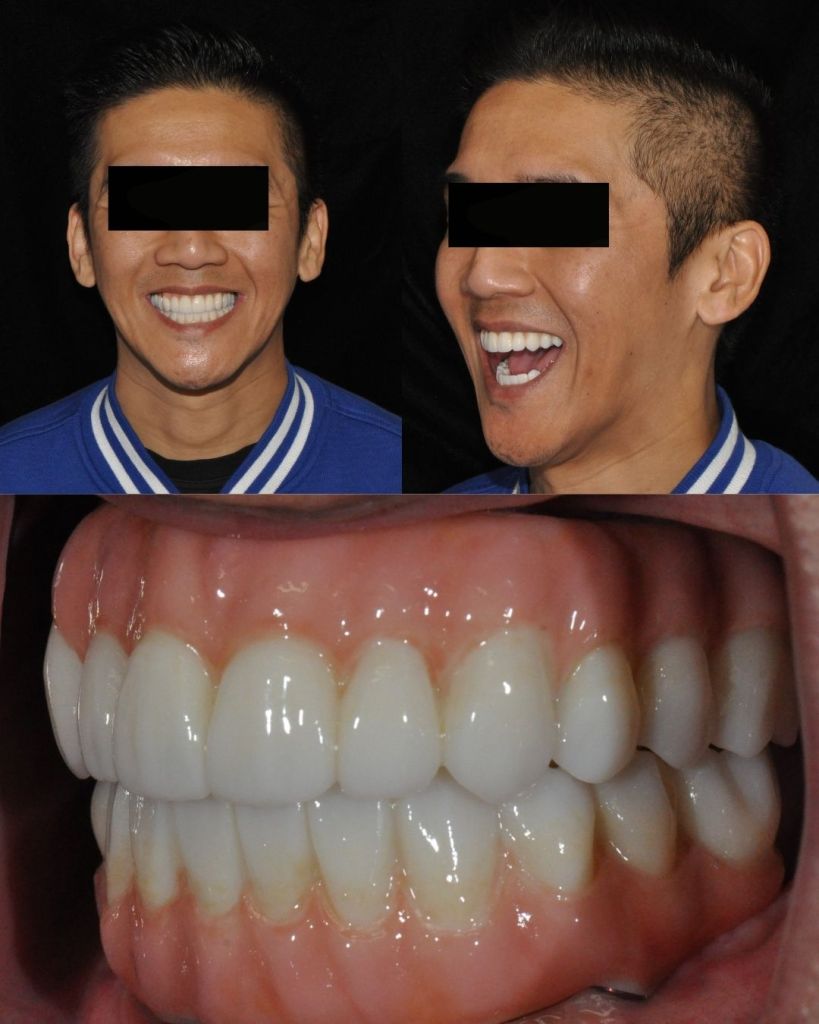 Man smiling after all-on-4 dental implant restorations