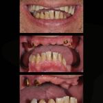Man's smile before all-on-4 dental implant restorations