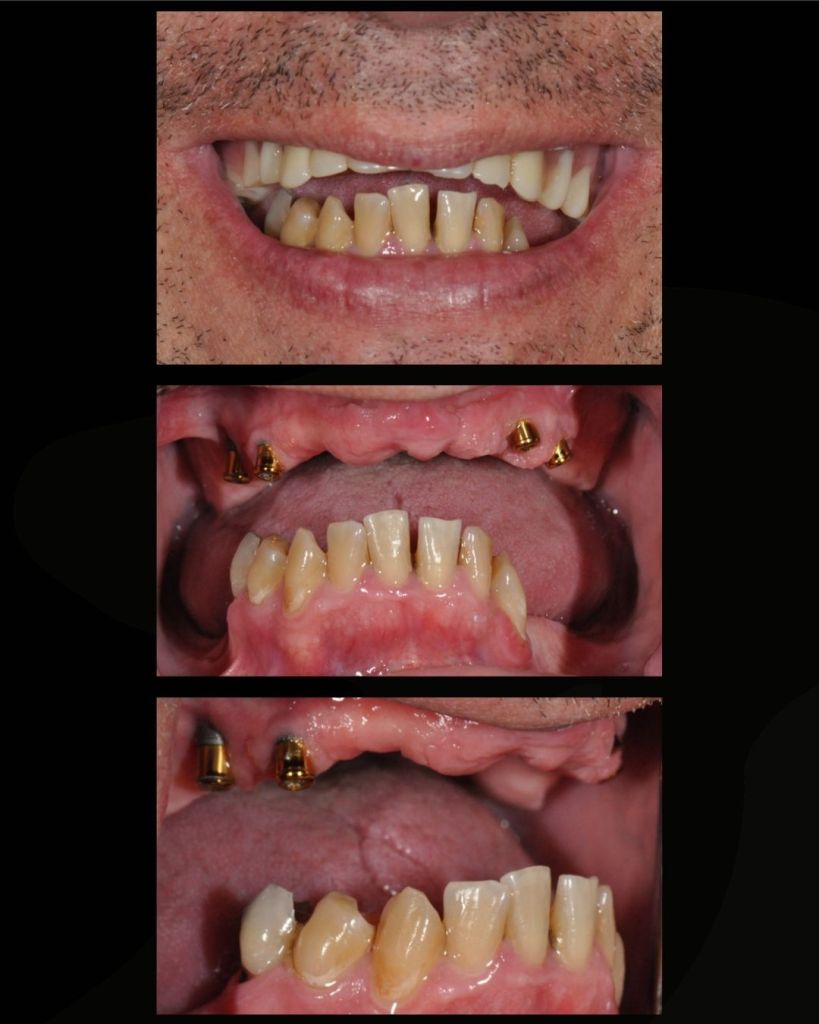 Man's smile before all-on-4 dental implant restorations