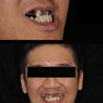 Man smiling before all-on-4 dental implant restorations