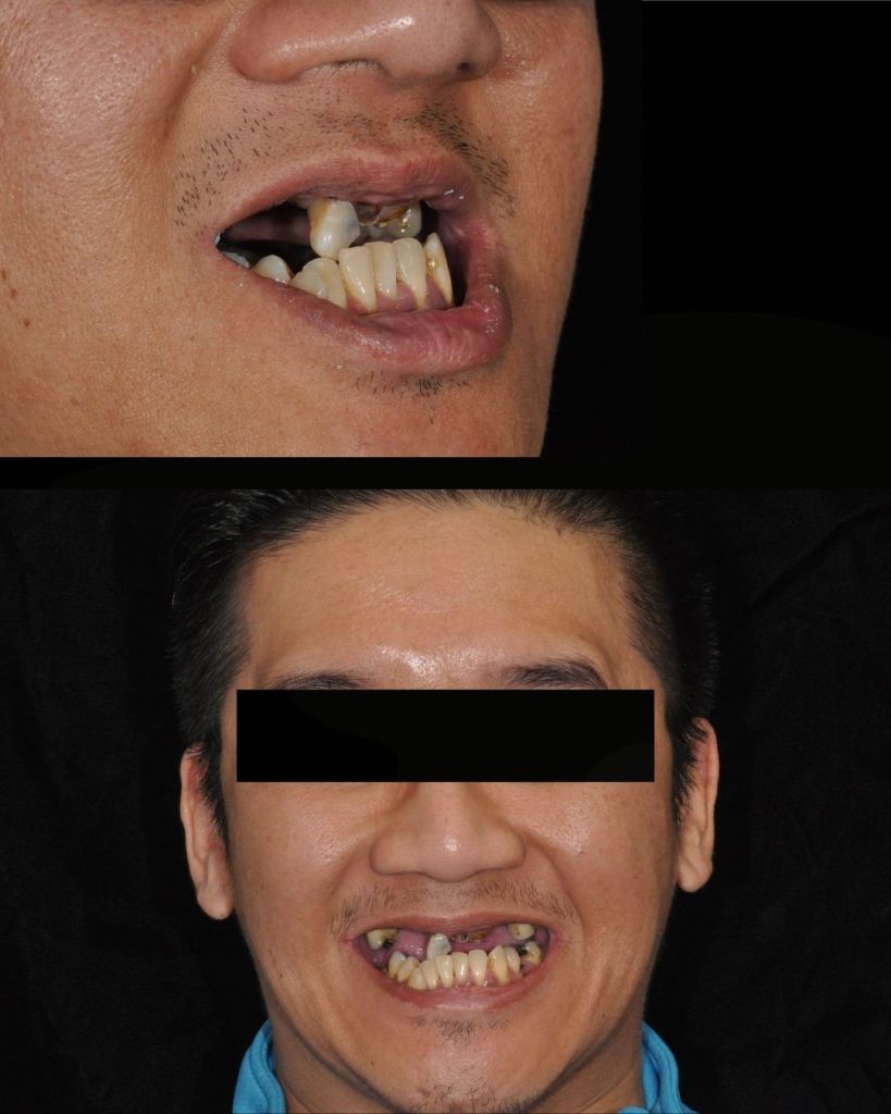Man smiling before all-on-4 dental implant restorations