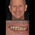 Man smiling before all-on-4 dental implant restorations