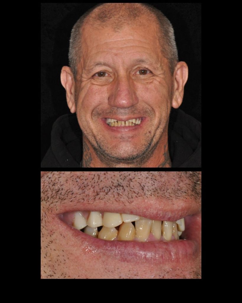 Man smiling before all-on-4 dental implant restorations