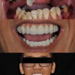 Man smiling before and after all-on-4 dental implant restorations