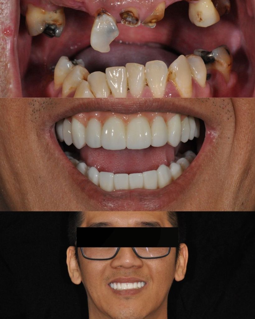 Man smiling before and after all-on-4 dental implant restorations