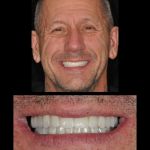 Man smiling after all-on-4 dental implant restorations