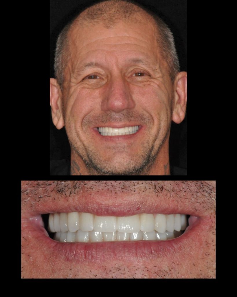 Man smiling after all-on-4 dental implant restorations
